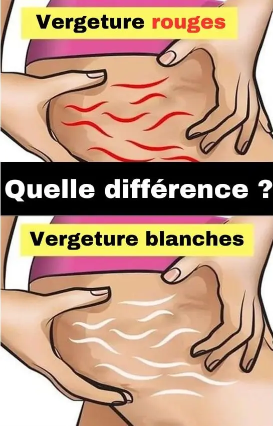 Vergetures rouge vs vergetures blanches