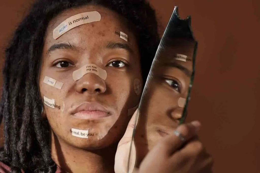 Femme noire avec de l'acné