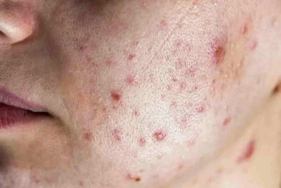 Arrêter d’avoir de l’acné de manière 100% naturelle